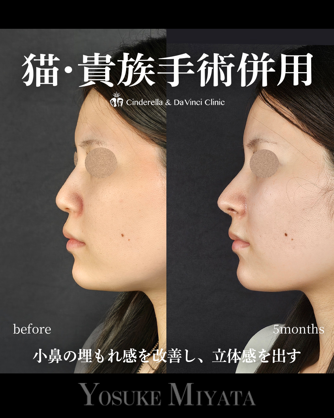 小鼻の埋もれ改善の画像