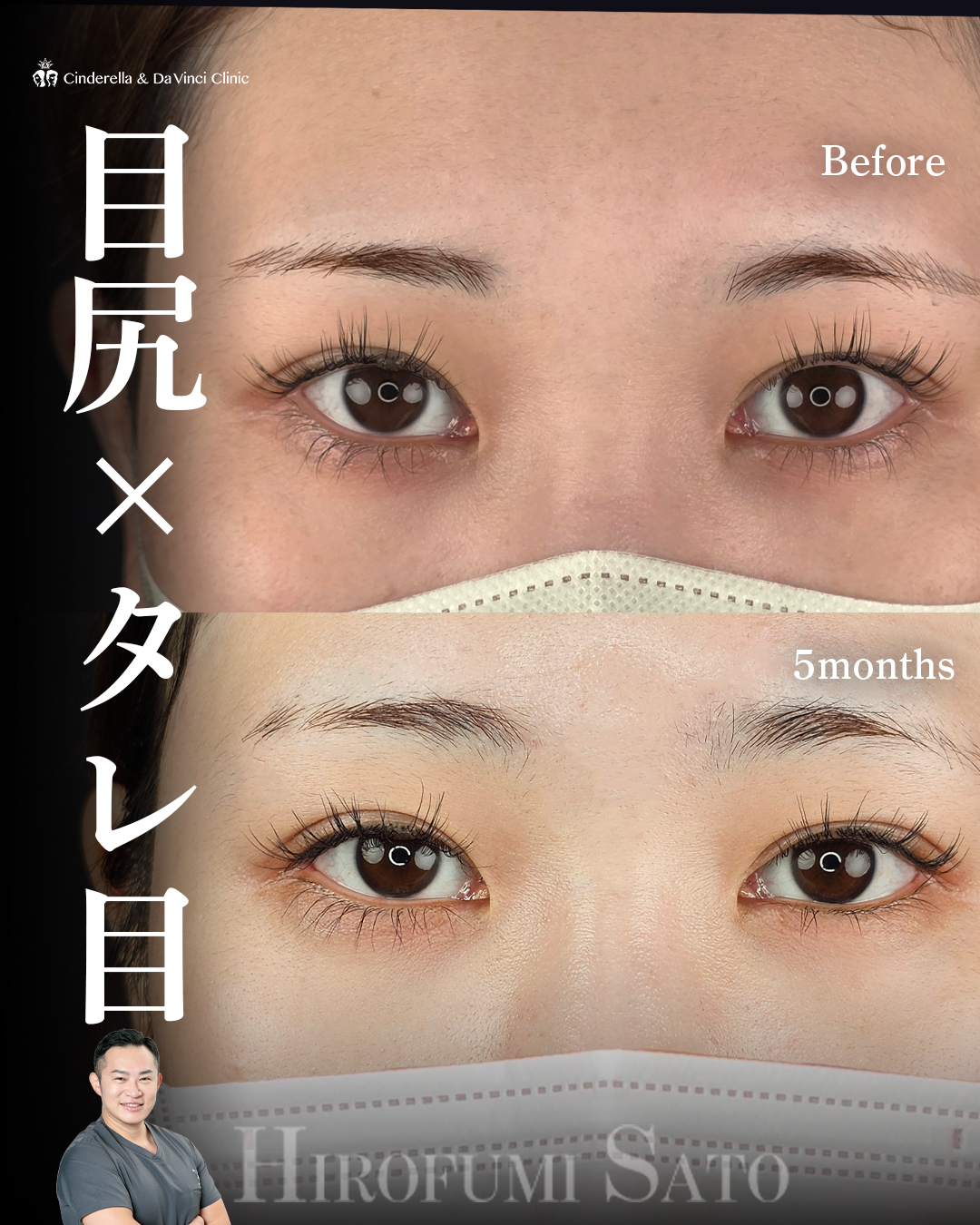 タレ目と目尻切開の画像