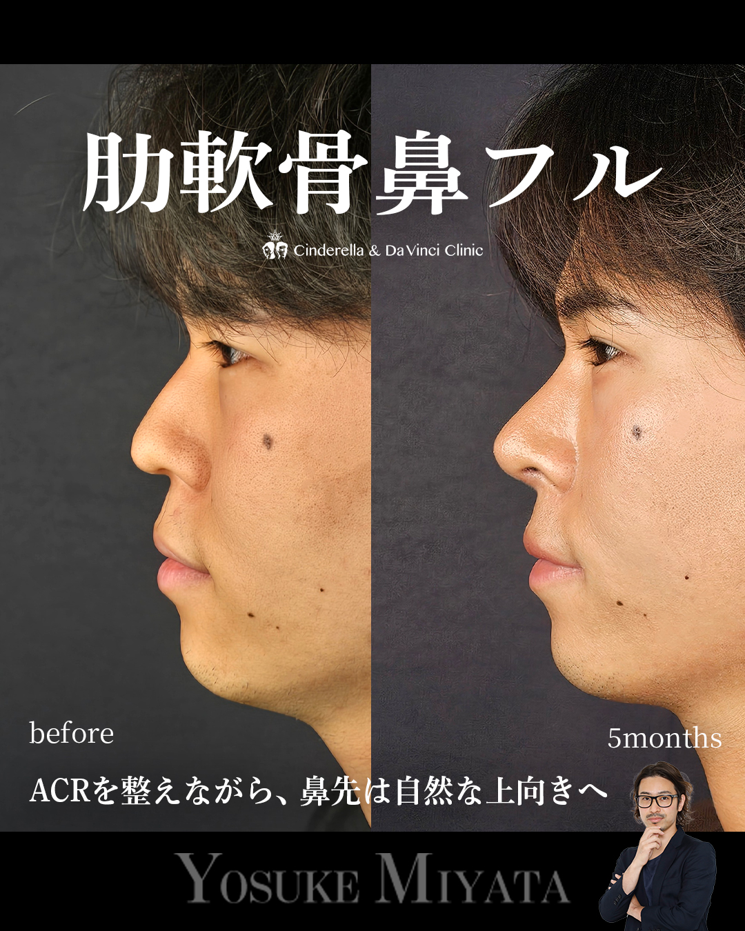 肋軟骨鼻フルの画像