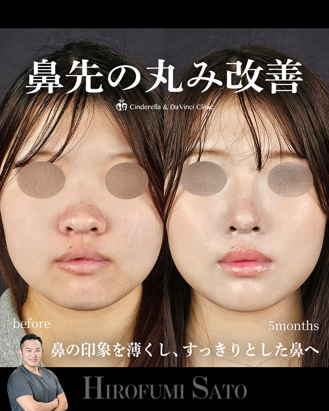 鼻先の丸み改善の画像