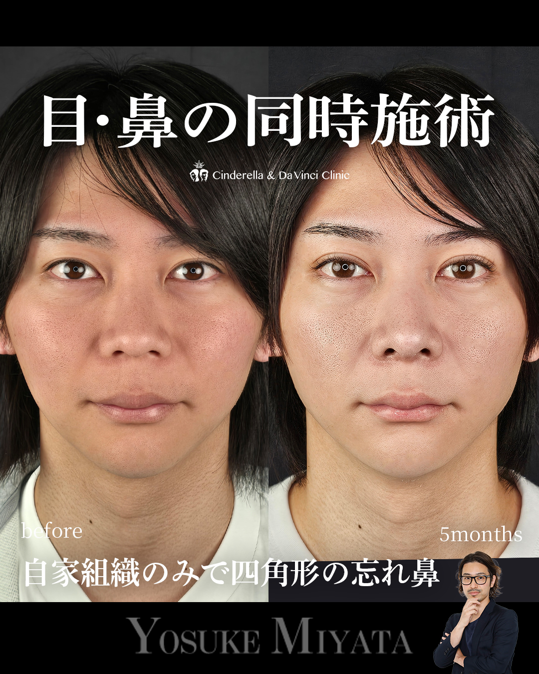 目と鼻同時の画像