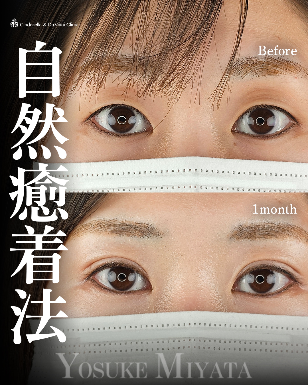 アイプチ卒業