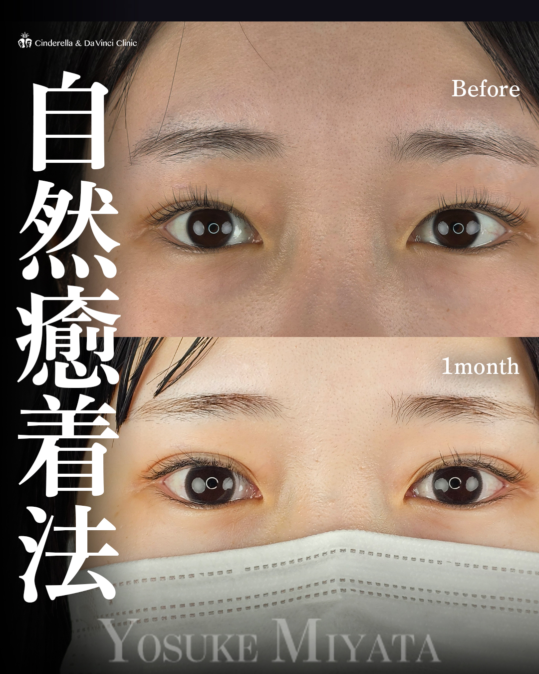 自然癒着法で華やかな二重に | 名古屋の美容外科・美容皮膚科なら