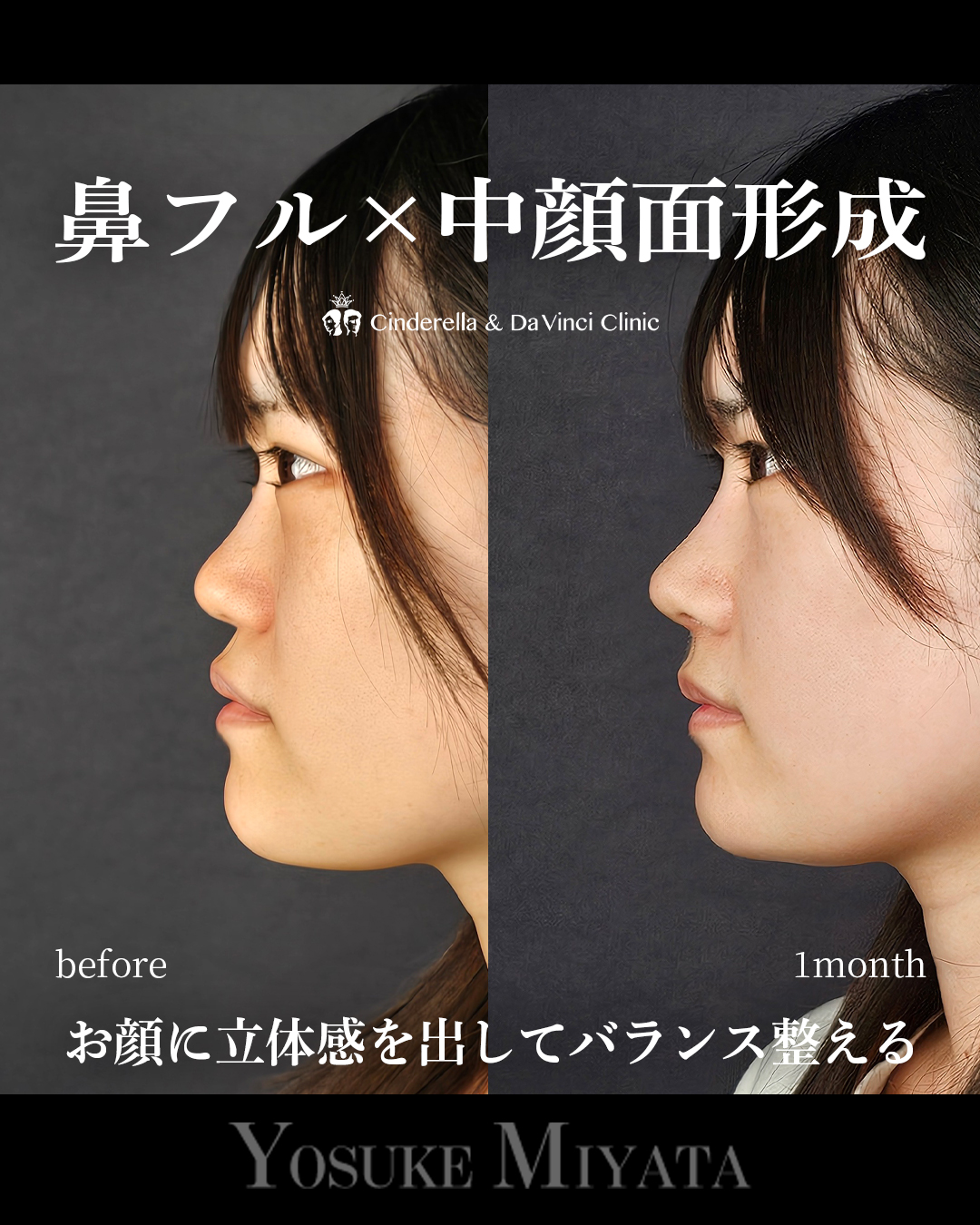 鼻フル×中顔面