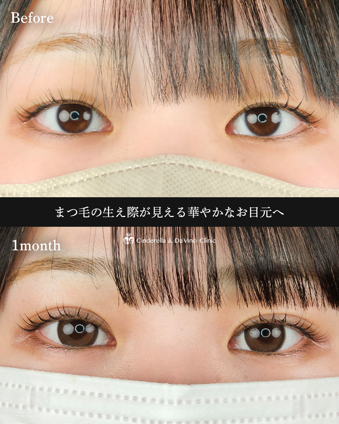 パッチリ二重の画像