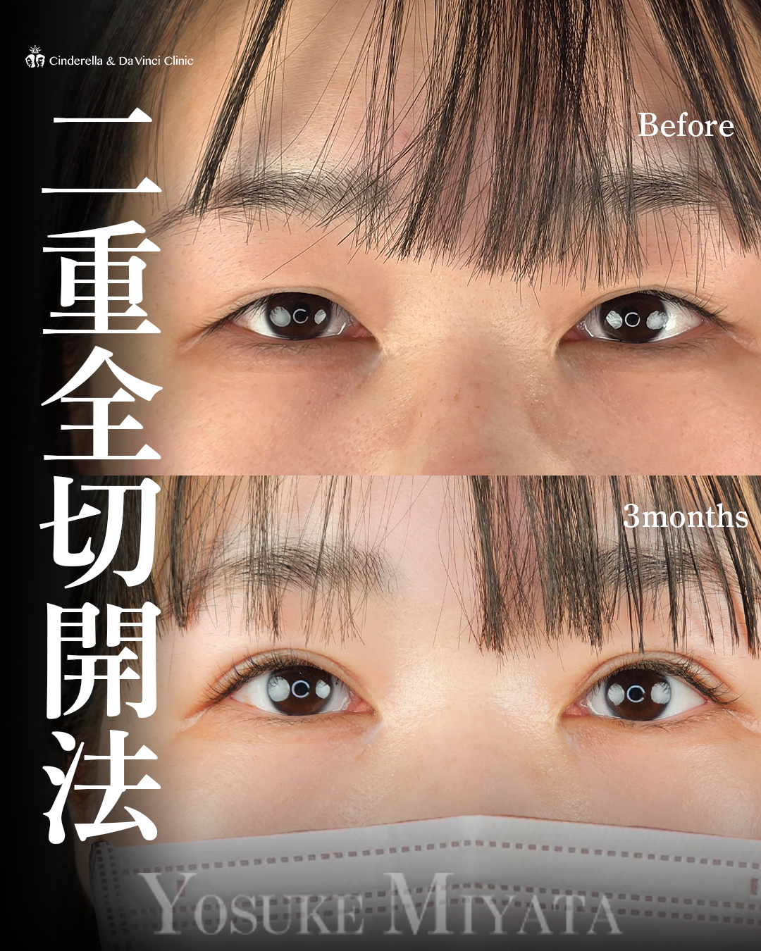 切開でつくる二重