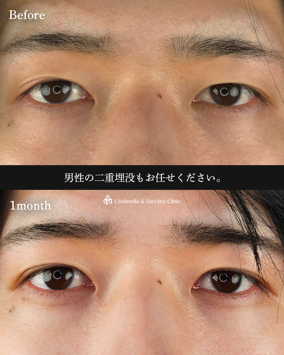 男性の二重埋没の画像