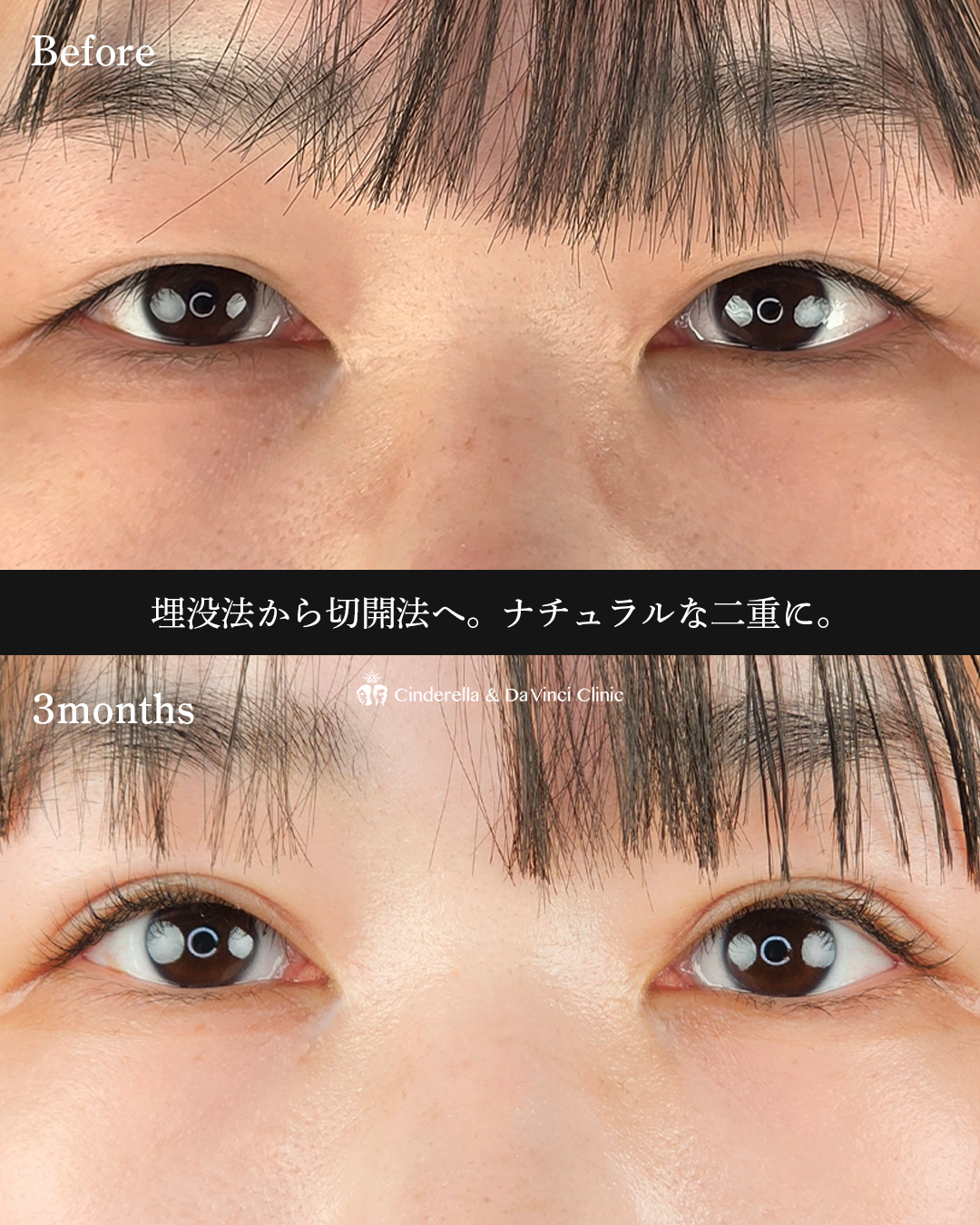 切開でつくる二重の画像