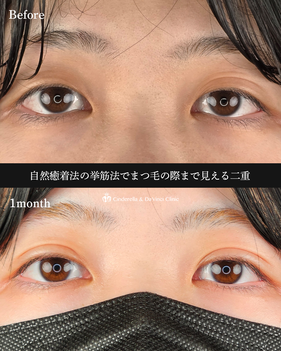 自然癒着法で二重にの画像