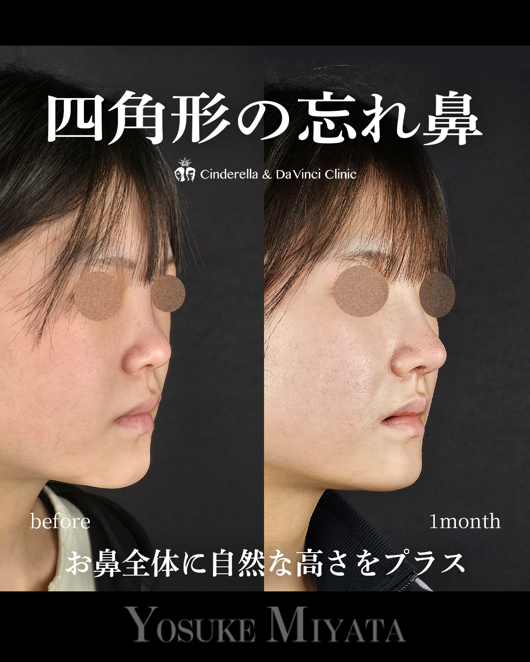 四角形の忘れ鼻の画像