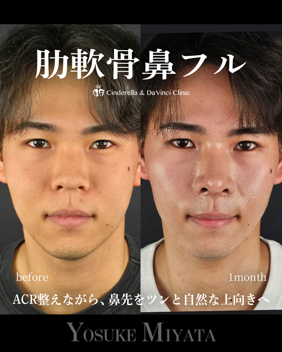 肋軟骨鼻フルの画像