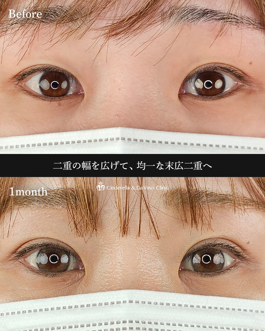 埋没で明るいお目元にの画像