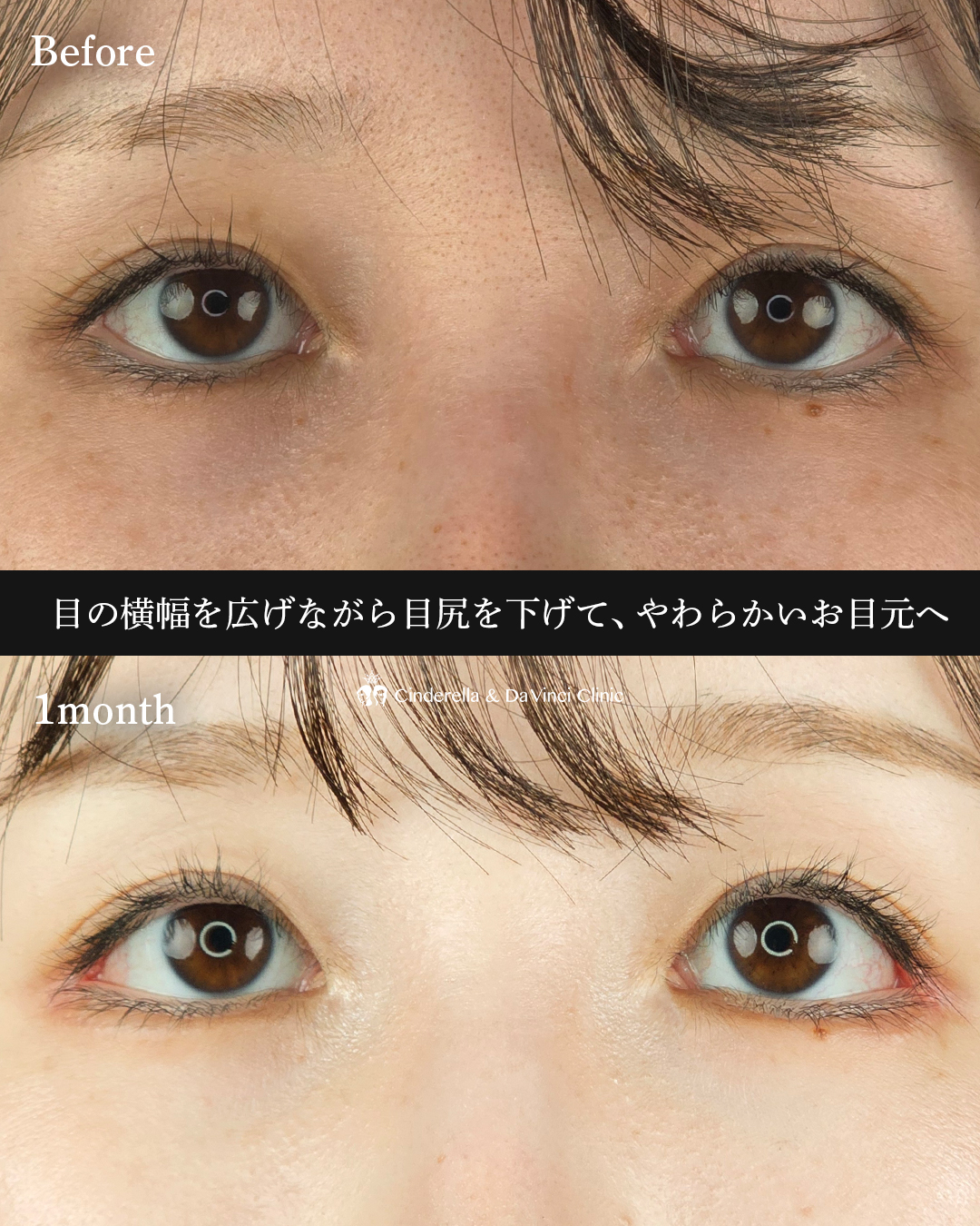 タレ目尻切開の画像