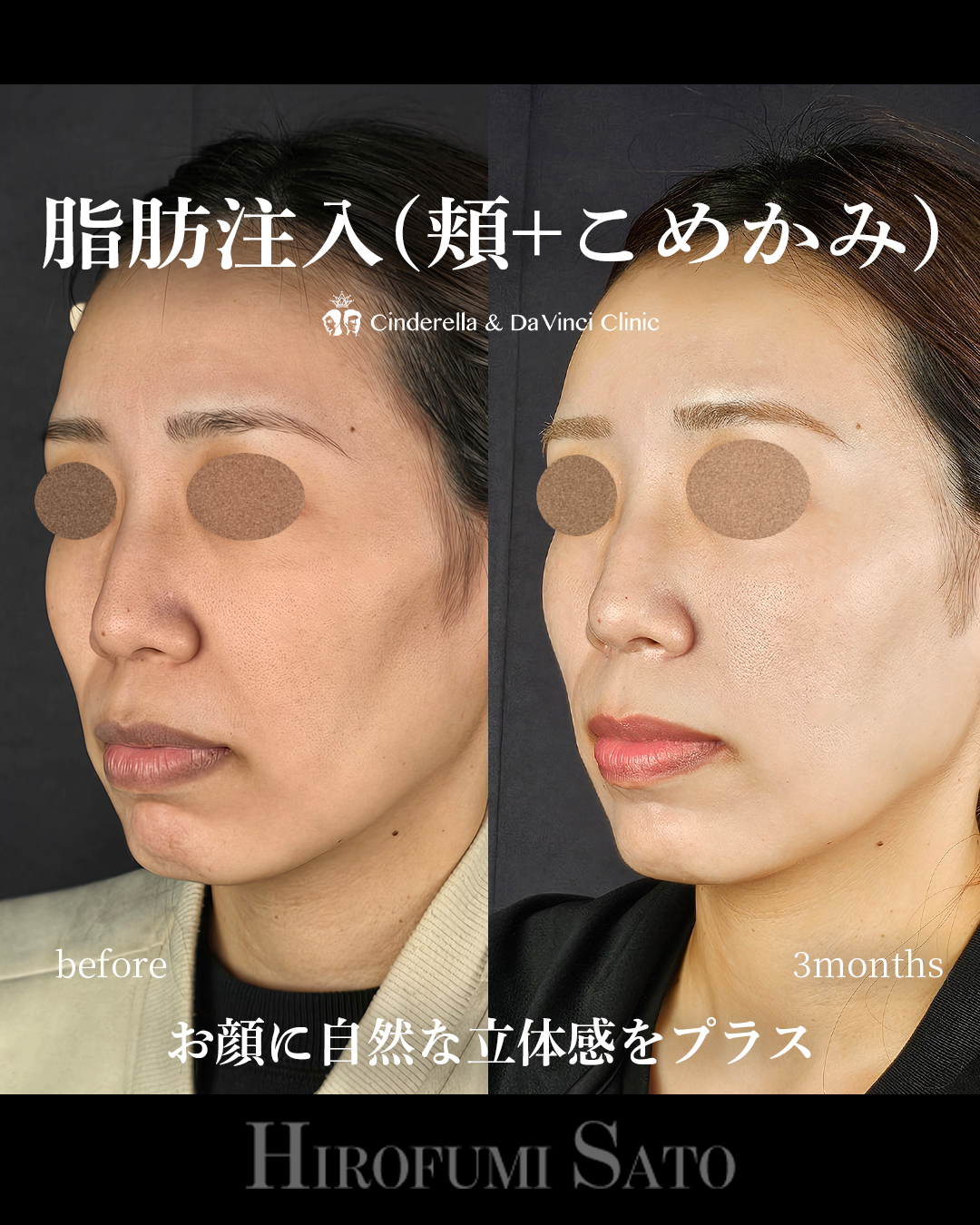 頬コケの脂肪注入の画像