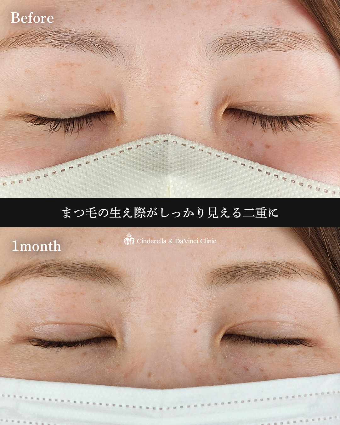 ぱっちり二重の画像