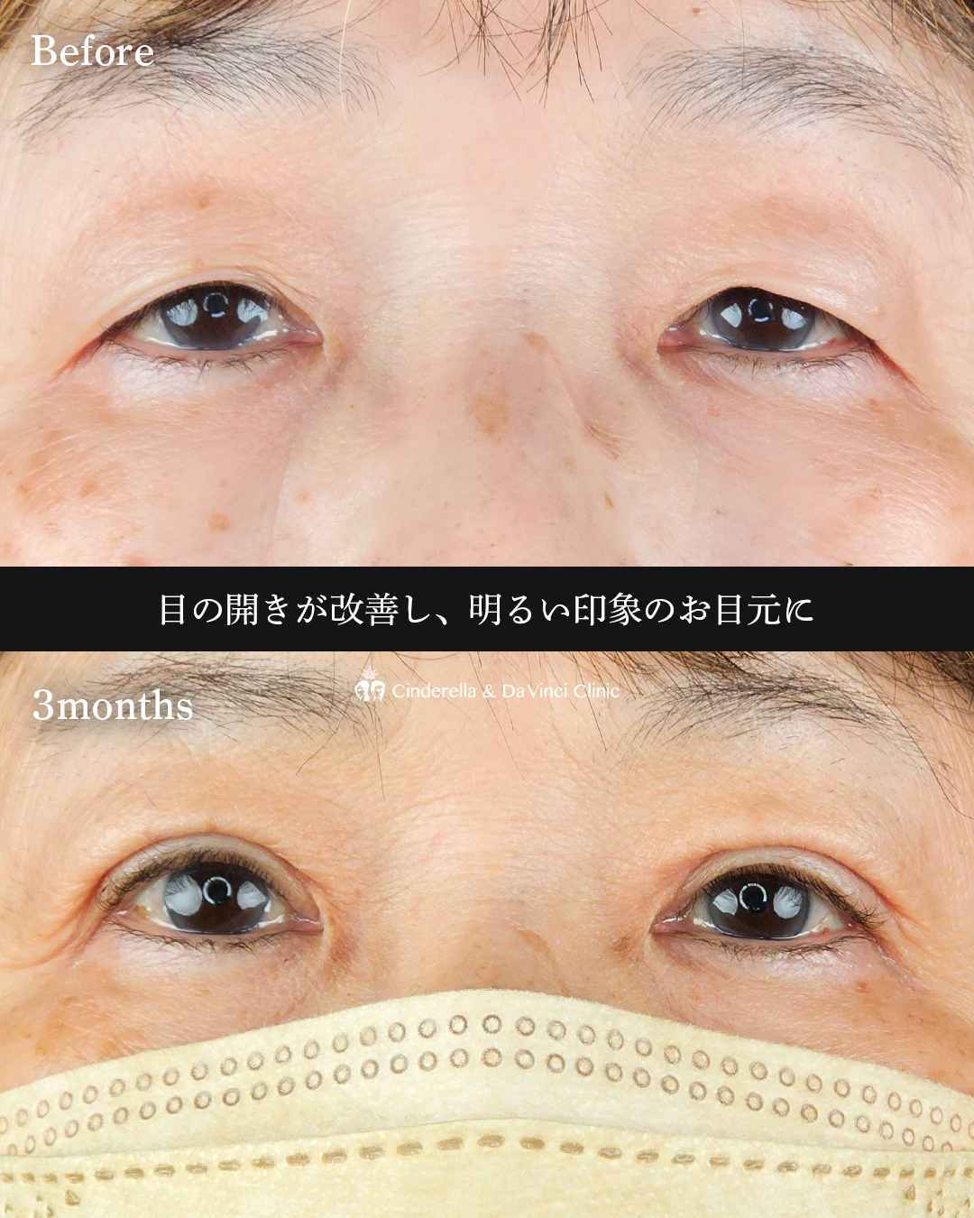 目の開き改善の画像