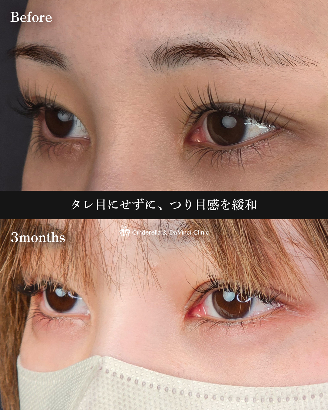 タレ目と目尻切開の画像