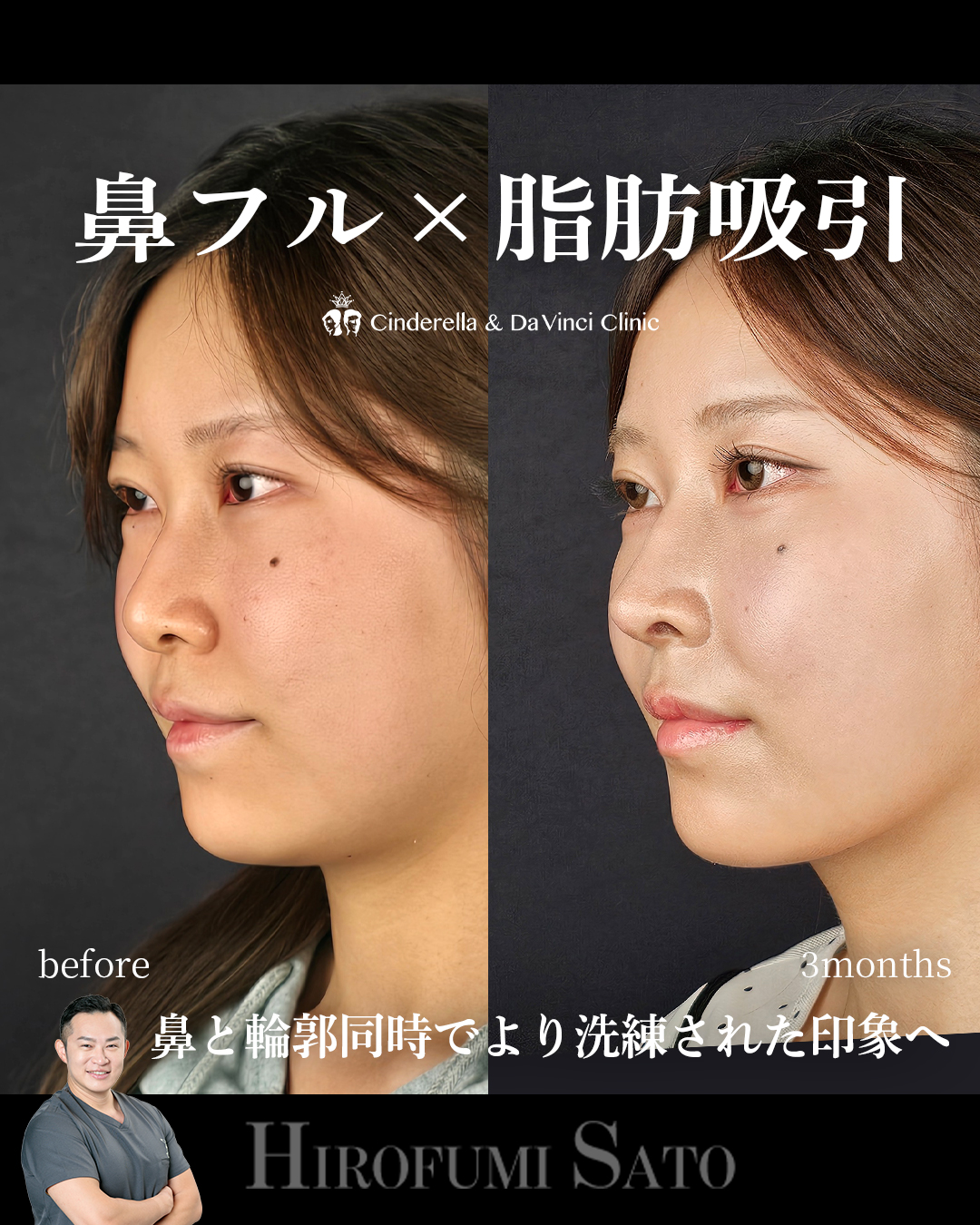 脂肪吸引と鼻整形の画像