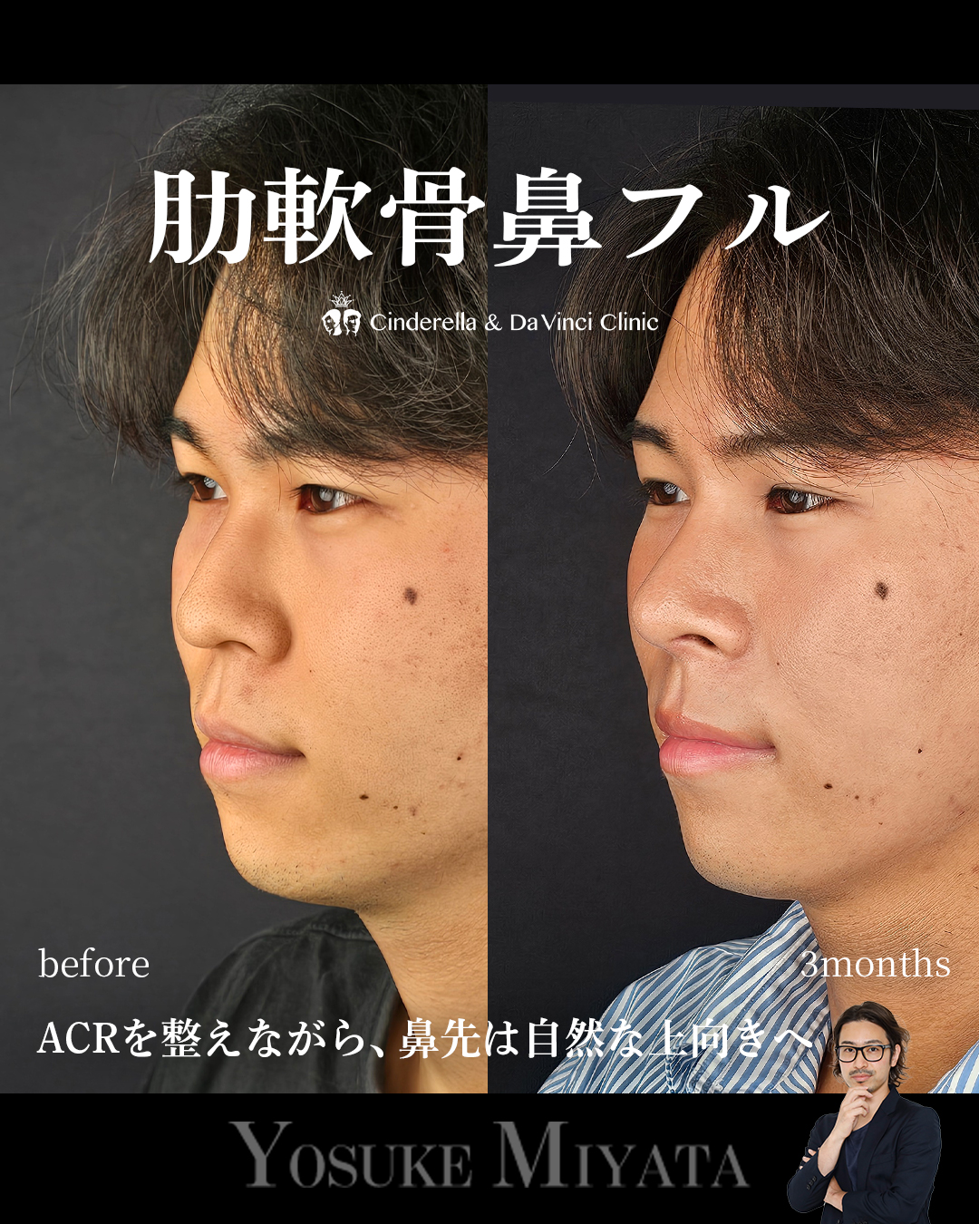 肋軟骨鼻フルの画像