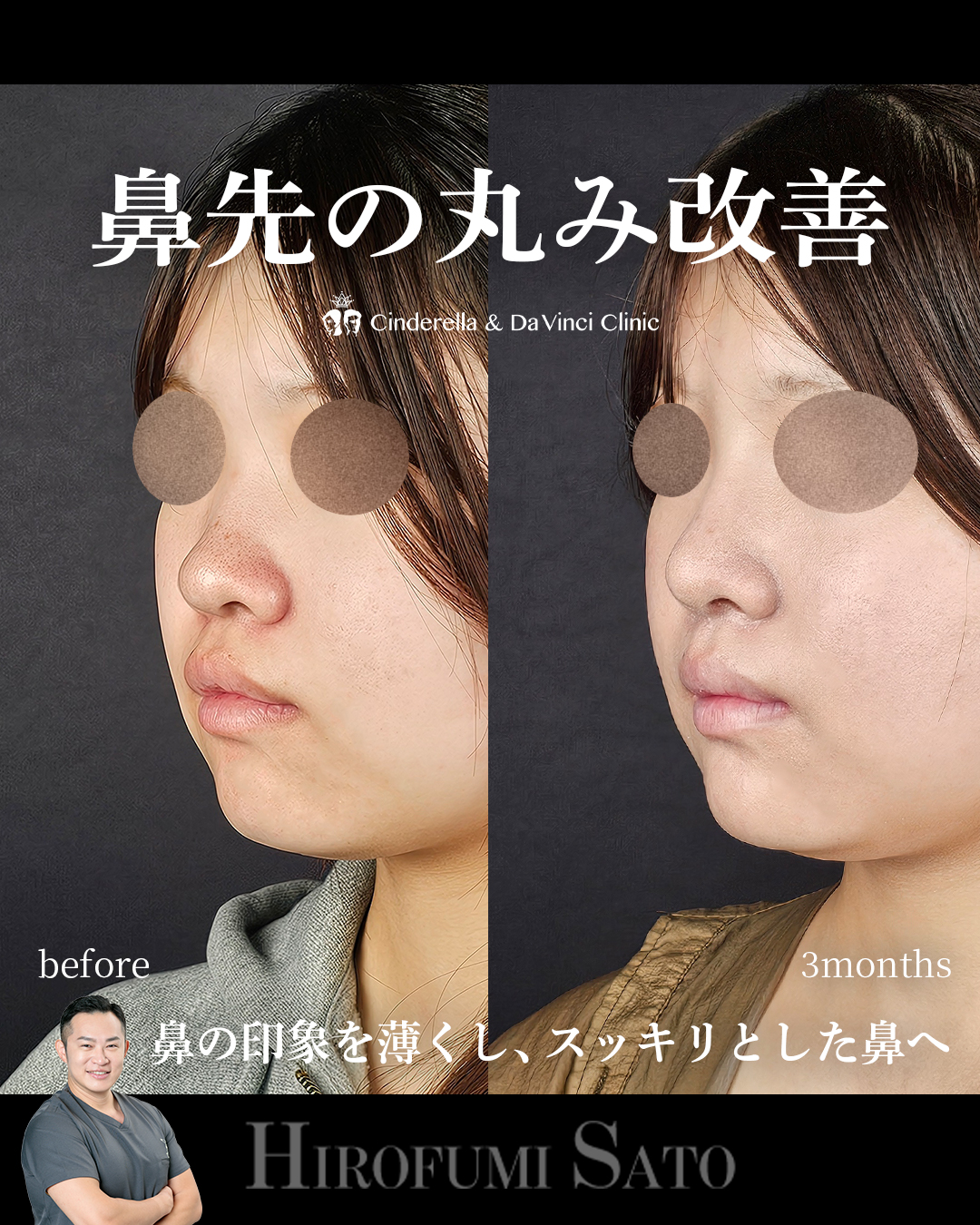 鼻先の丸み改善の画像