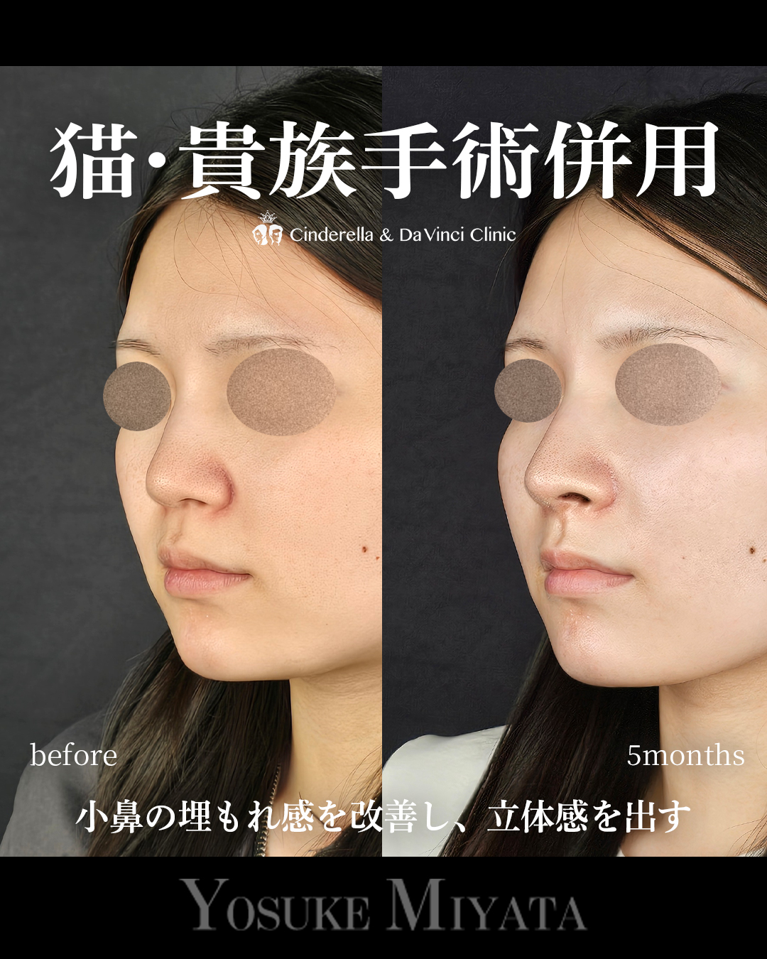 小鼻の埋もれ改善の画像