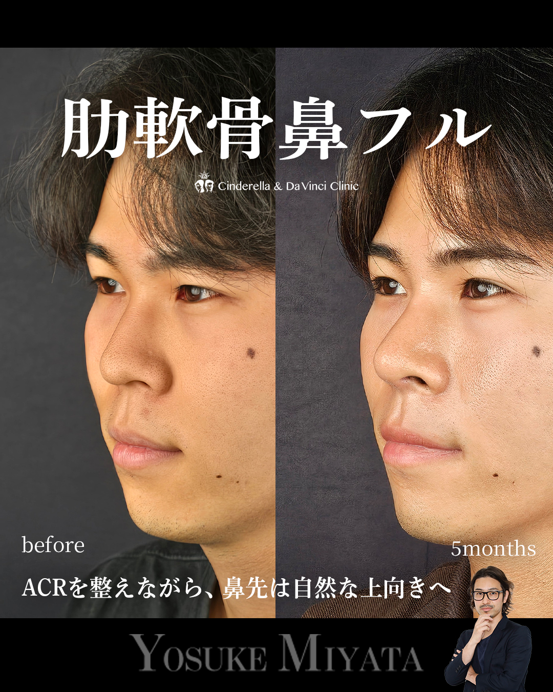 肋軟骨鼻フルの画像