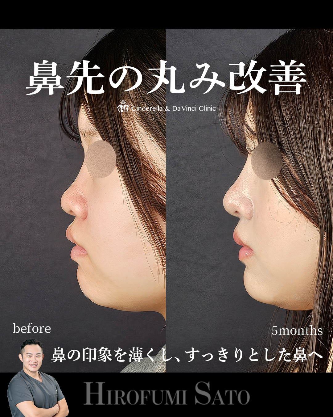 鼻先の丸み改善の画像
