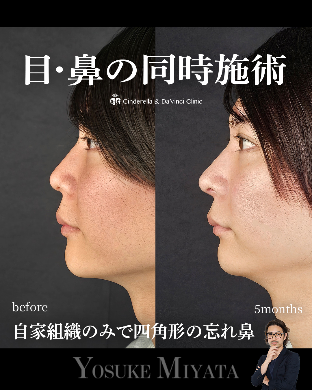 目と鼻同時の画像