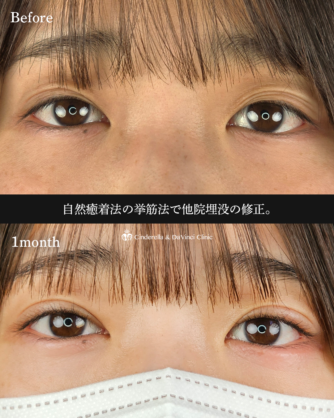 他院埋没の修正の画像