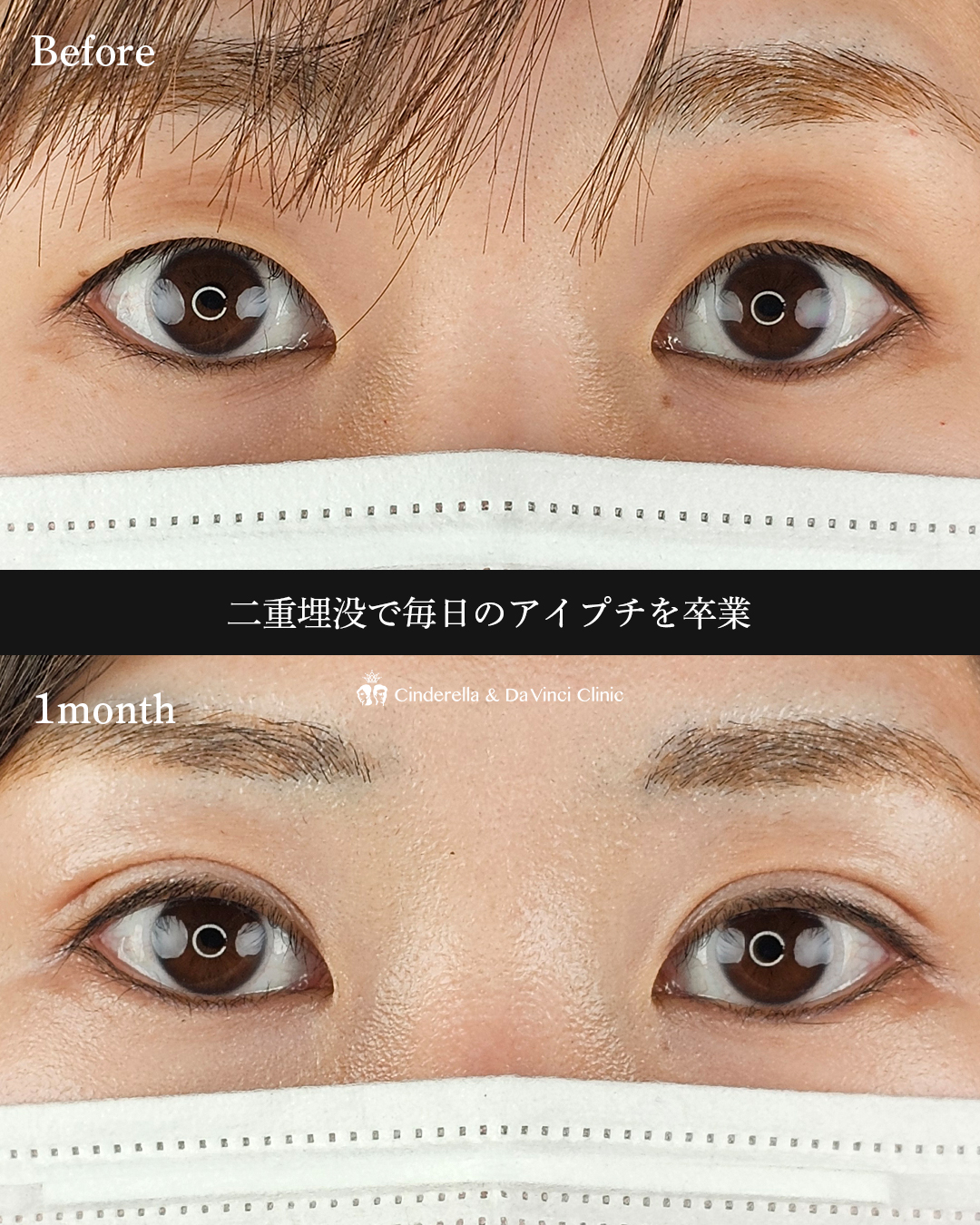 アイプチ卒業の画像