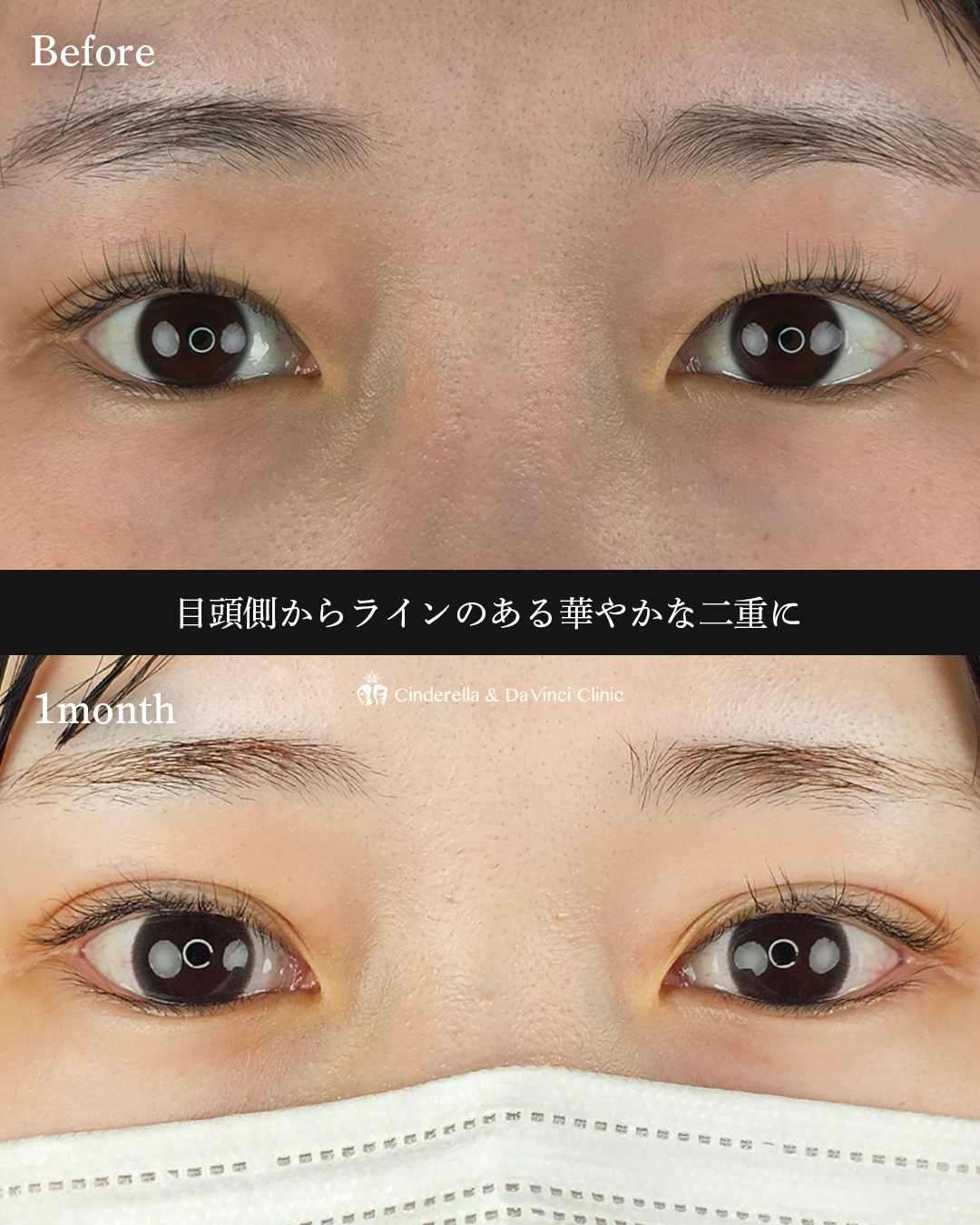 自然癒着法で華やかな二重にの画像