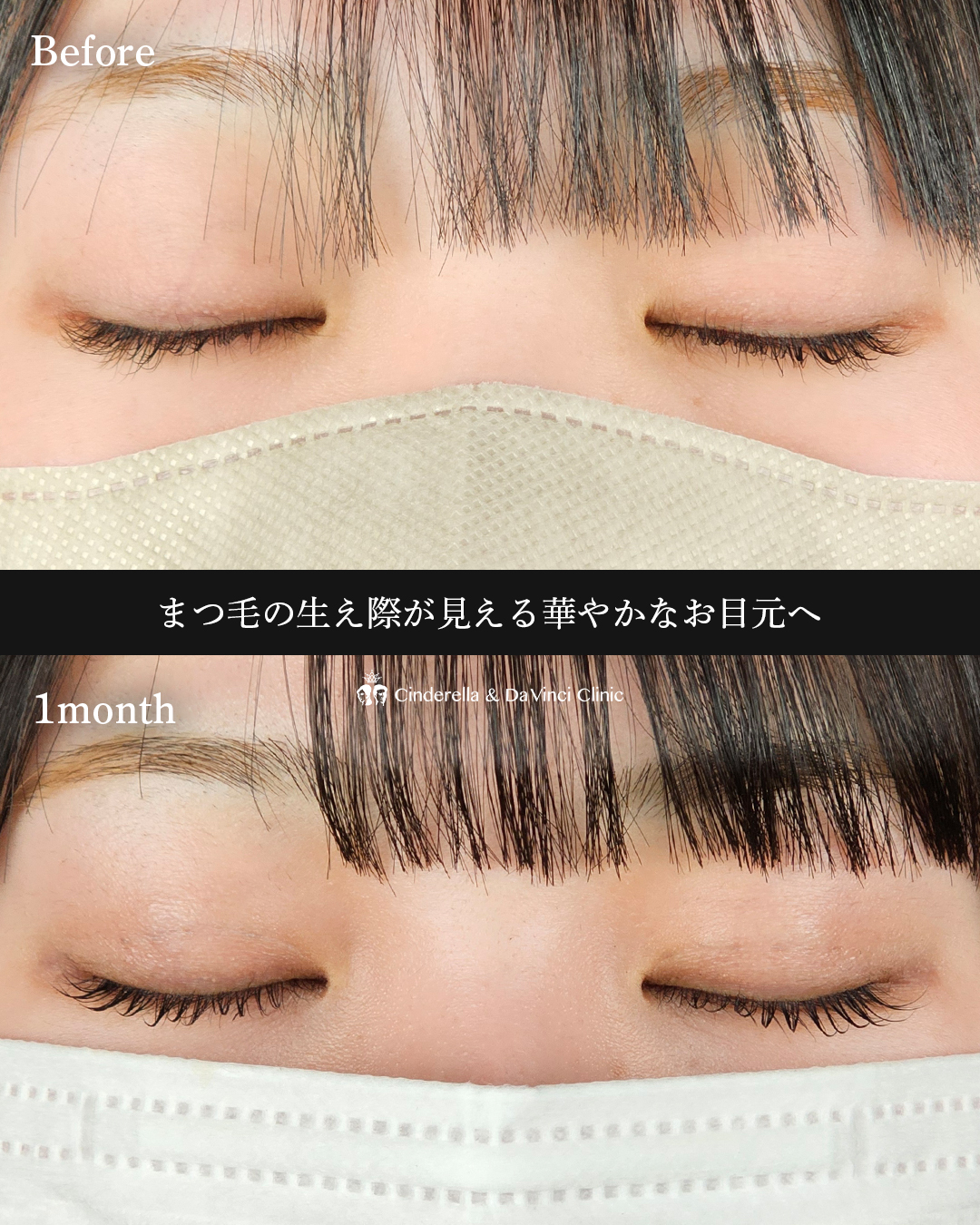 パッチリ二重の画像