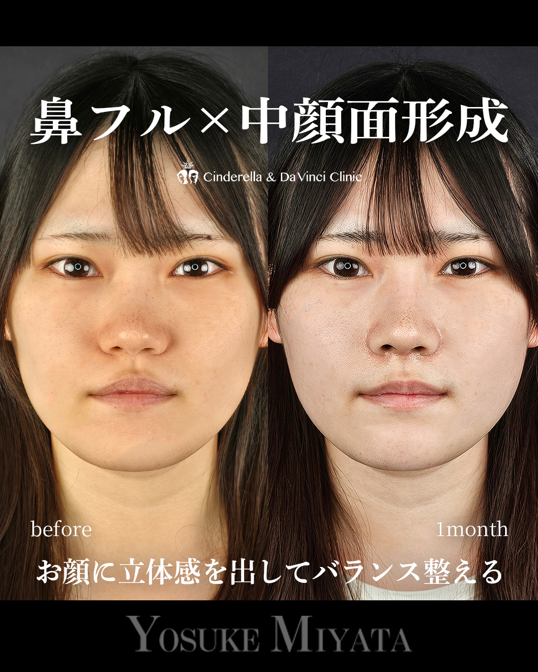 鼻フル×中顔面の画像