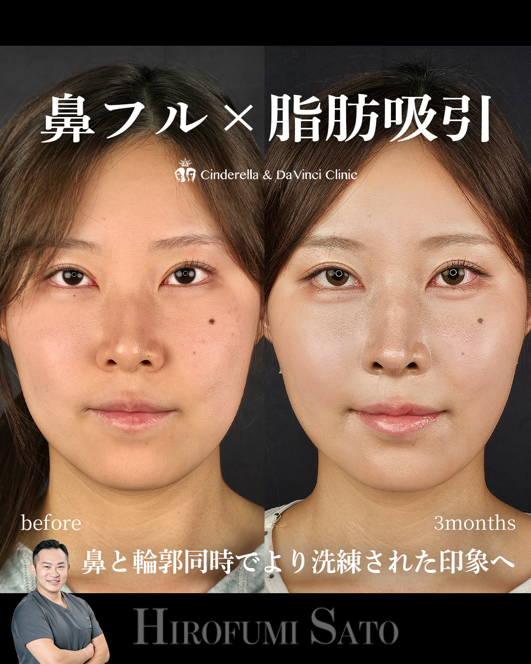 脂肪吸引と鼻整形の画像