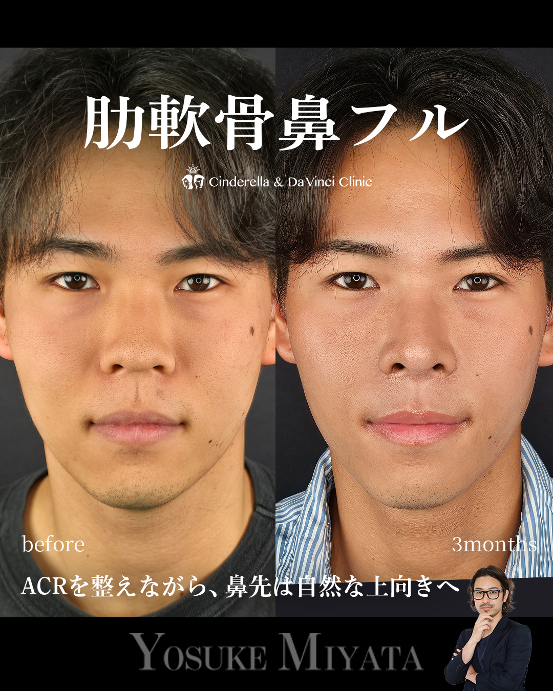 肋軟骨鼻フルの画像