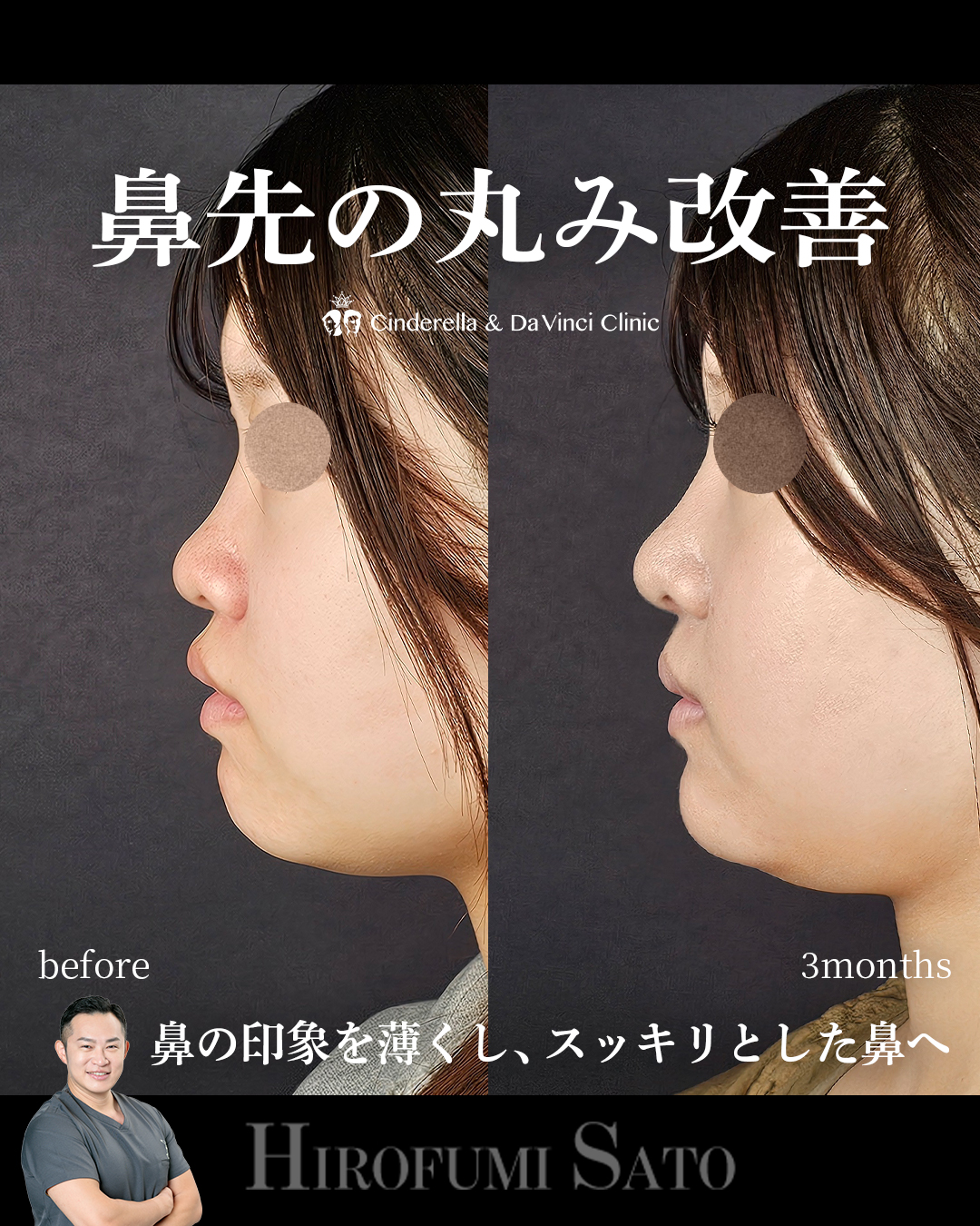 鼻先の丸み改善の画像