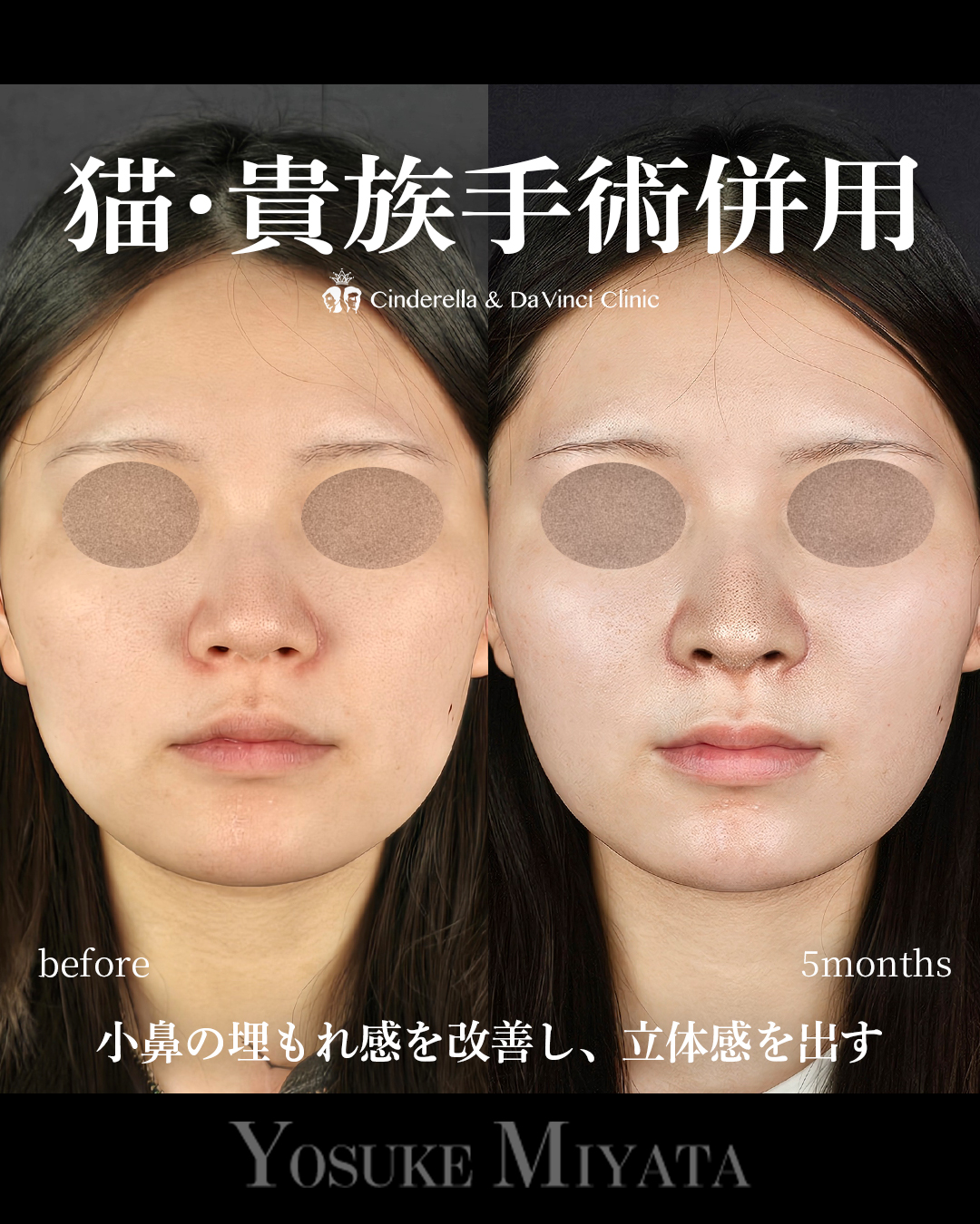 小鼻の埋もれ改善の画像
