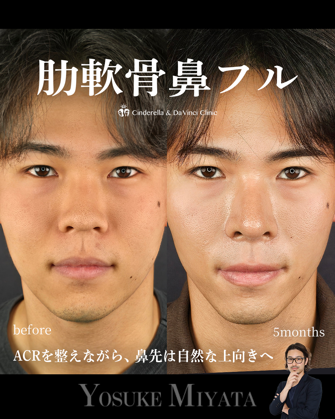 肋軟骨鼻フルの画像