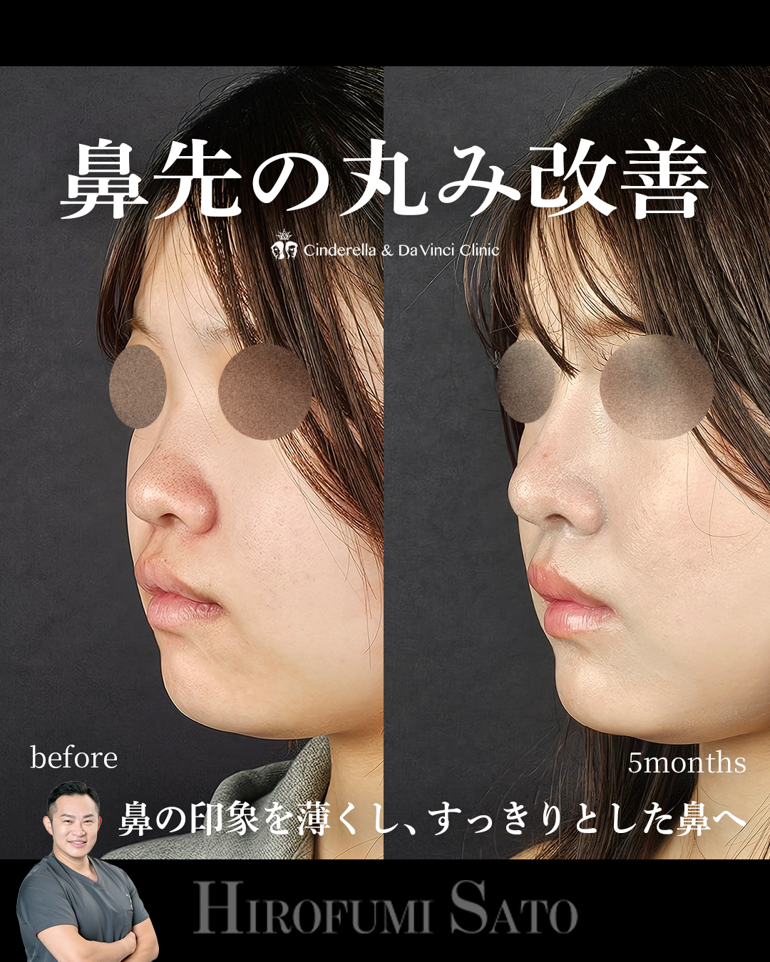 鼻先の丸み改善の画像