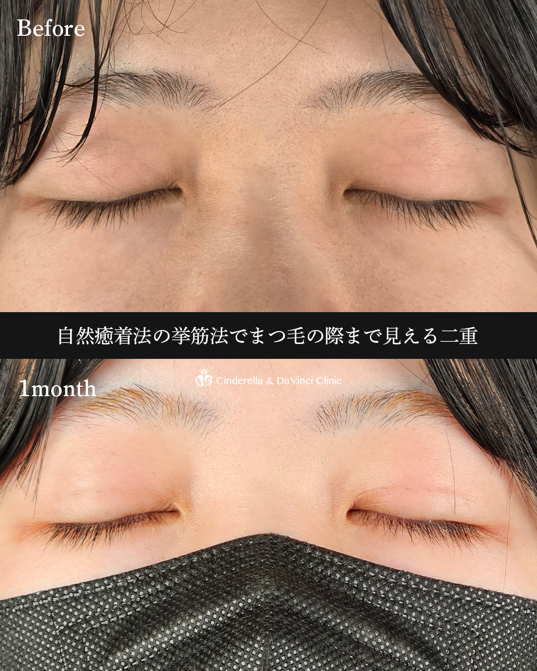 自然癒着法で二重にの画像
