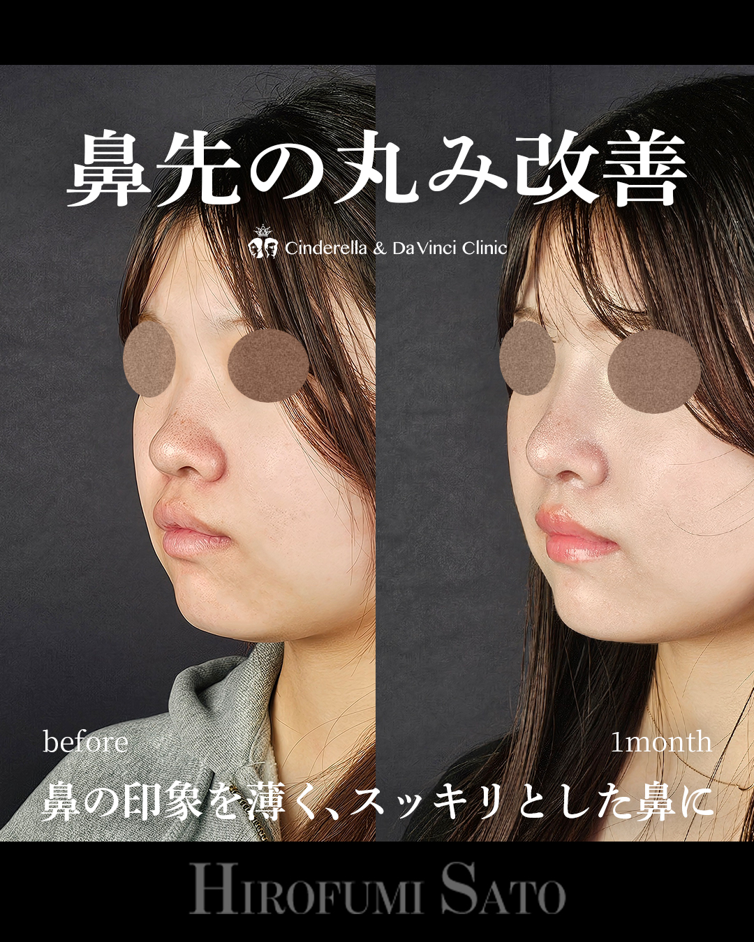 鼻先の丸み改善の画像