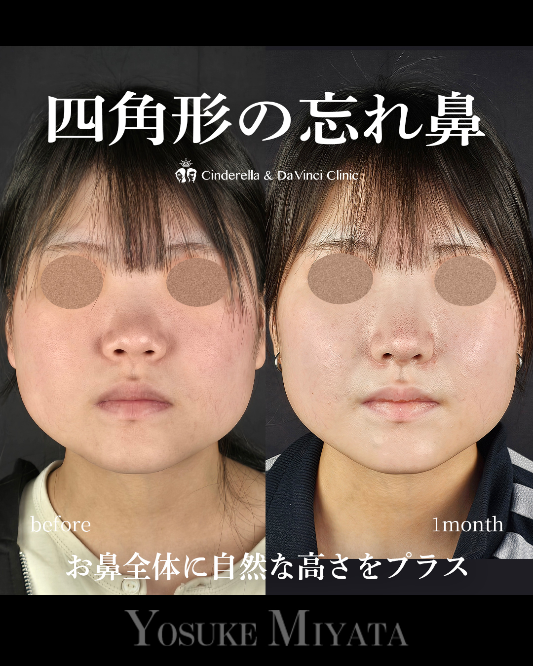 四角形の忘れ鼻の画像
