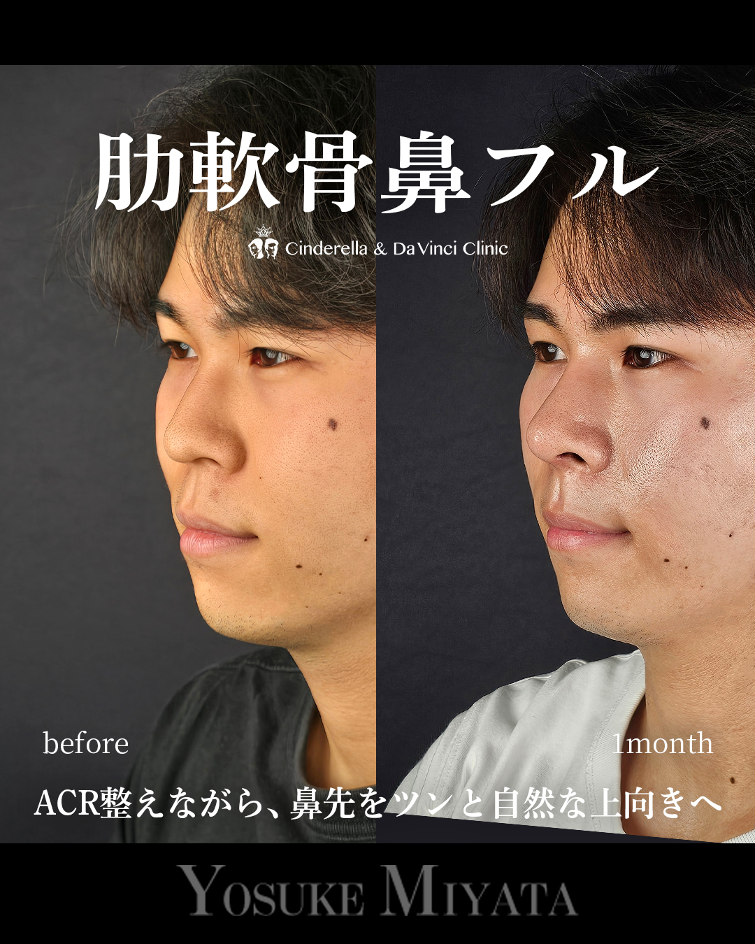 肋軟骨鼻フルの画像