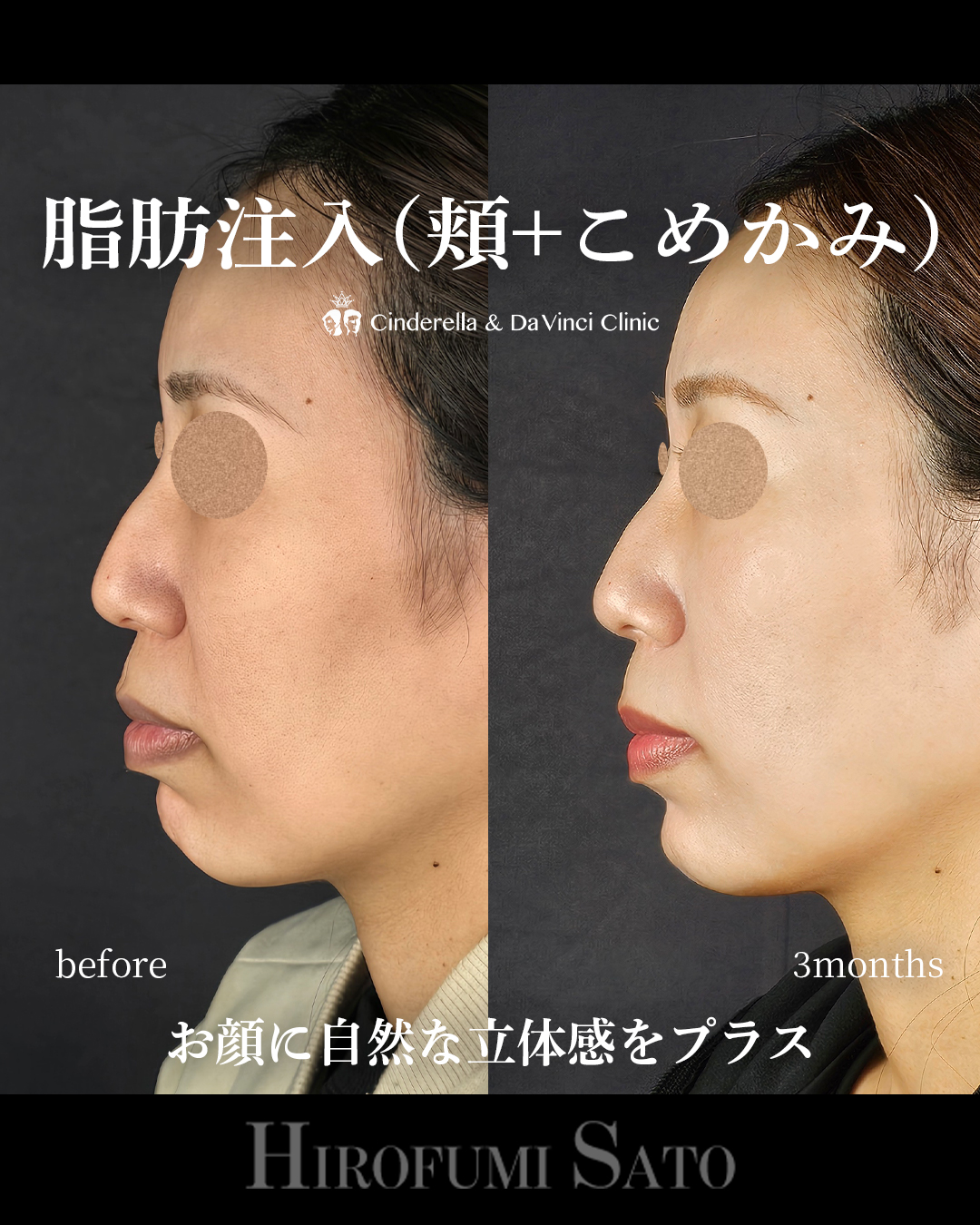 頬コケの脂肪注入の画像