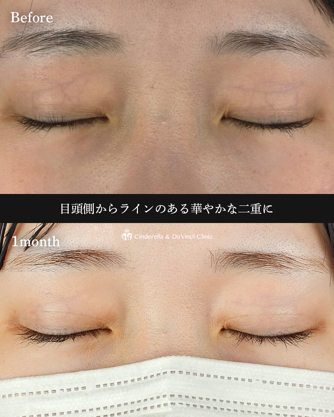 自然癒着法で華やかな二重にの画像