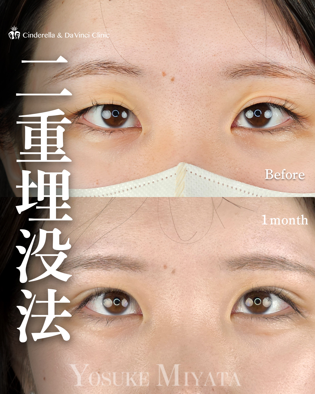 バレづらい末広の埋没
