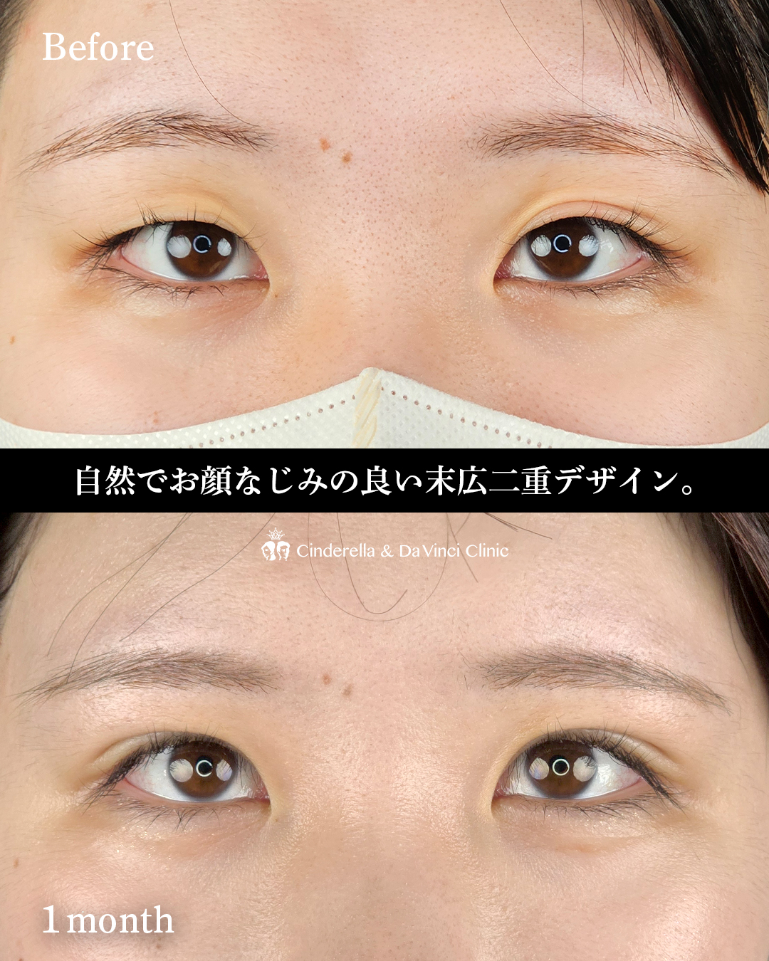 バレづらい末広の埋没の画像