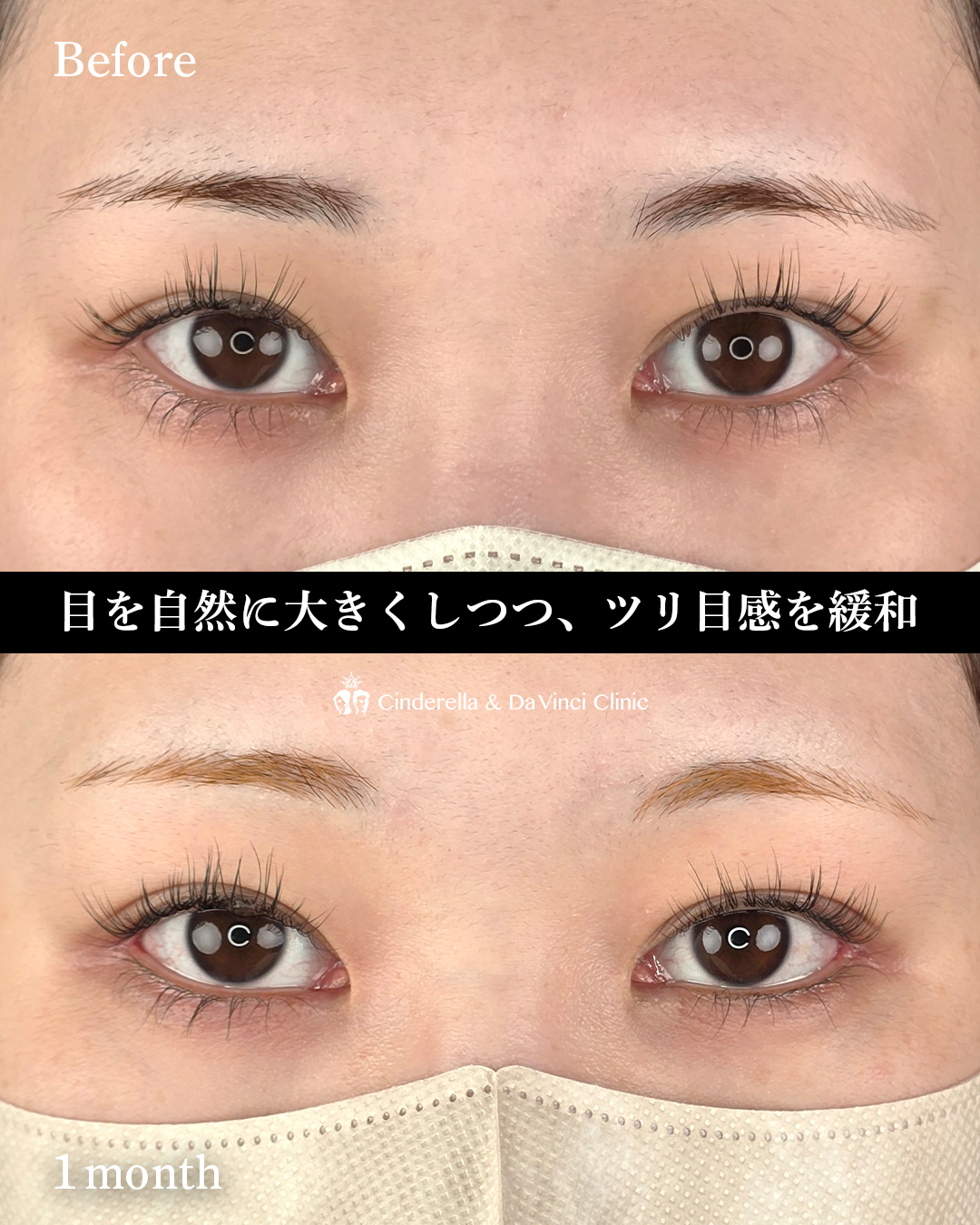 タレ目と目尻切開の画像