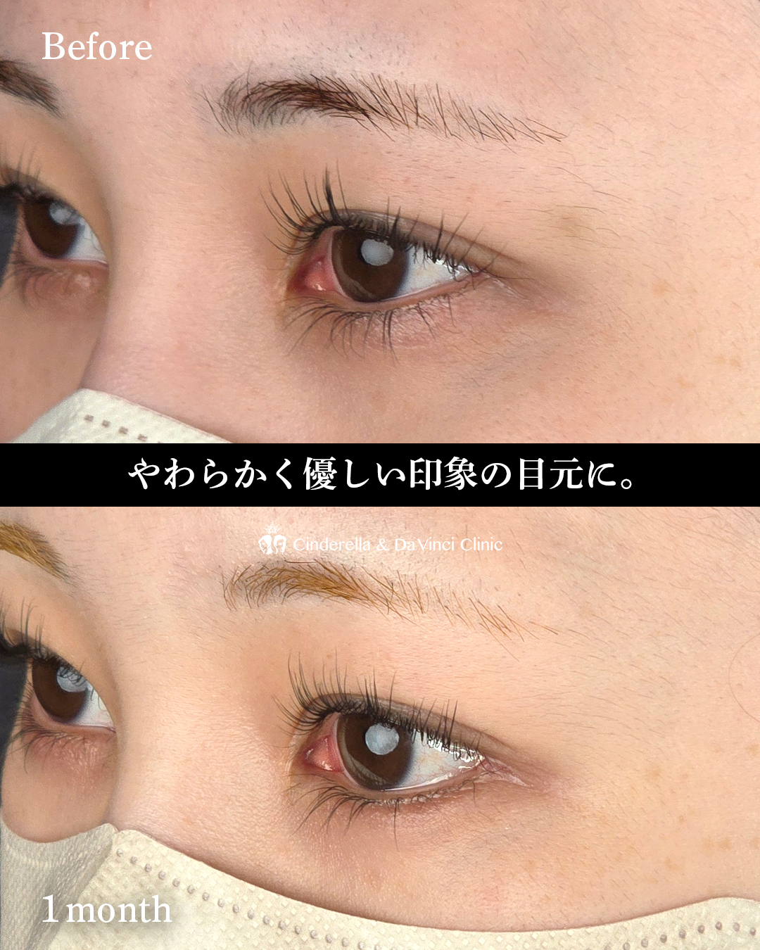 タレ目と目尻切開の画像
