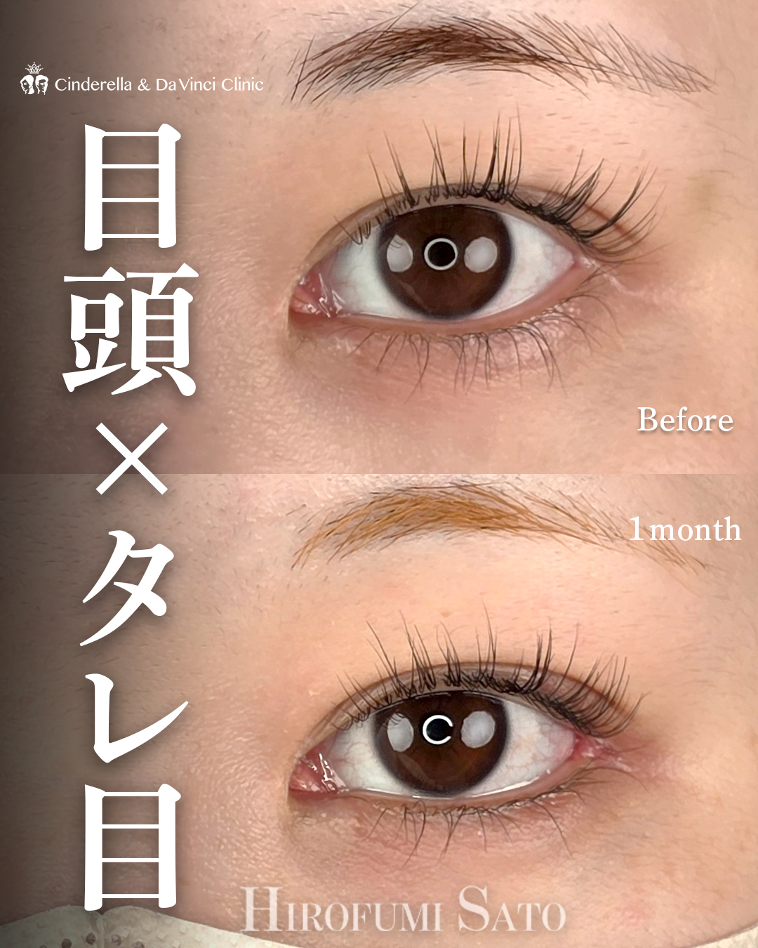 タレ目と目尻切開
